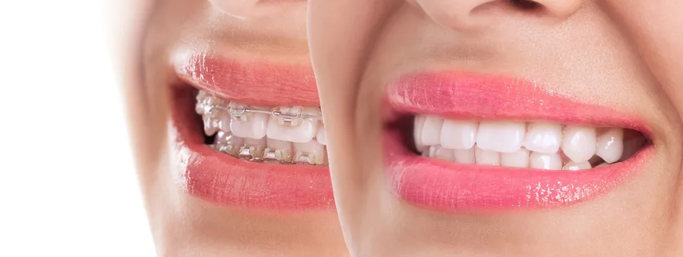 Clear Aligners VS. Braces